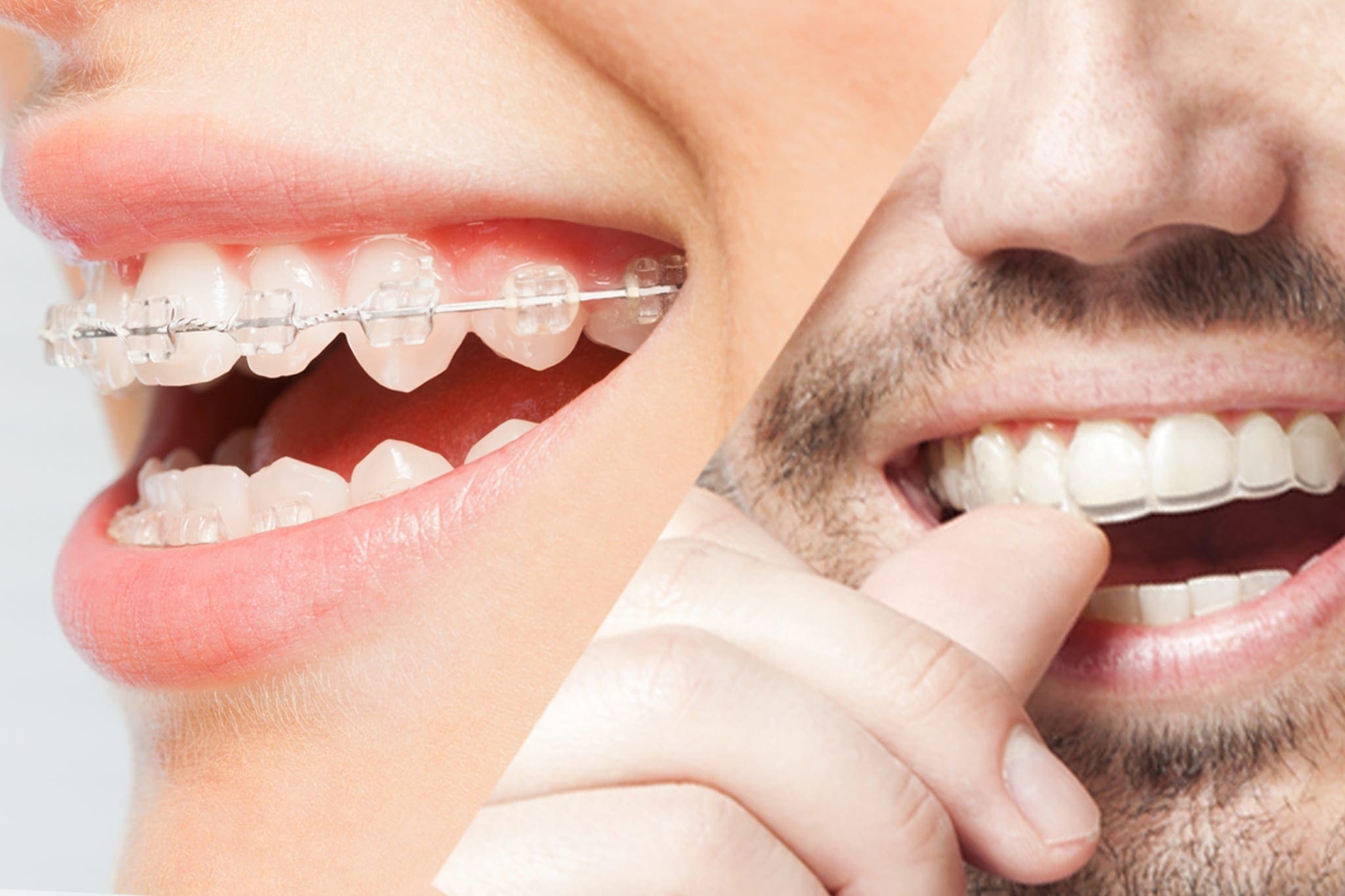 Braces-vs-aligners-bangladesh